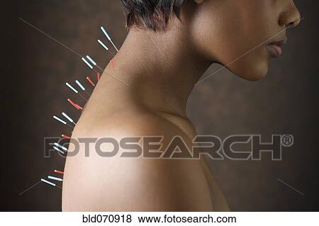 Stock Photo - Acupuncture needles in African woman's back. Fotosearch