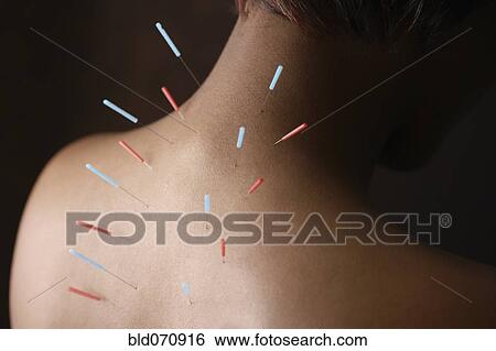 Acupuncture needles in African woman's back View Large Photo Image Stock Photograph - Acupuncture needles in African woman's back. Fotosearch