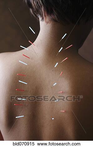 Acupuncture needles in African woman's back View Large Photo Image Stock Photography - Acupuncture needles in African woman's back. Fotosearch