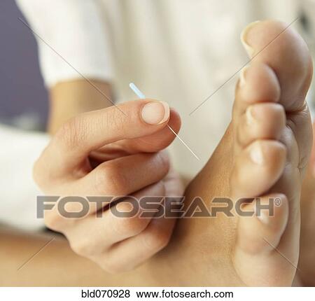 Close up of Acupuncture treatment View Large Photo Image Stock Photo - Close up of Acupuncture treatment. Fotosearch