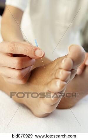 Stock Photo - Close up of Acupuncture treatment. Fotosearch