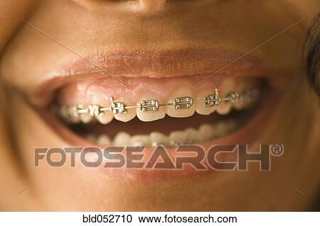 Stock Image - Close up of African woman with orthodontic braces. Fotosearch