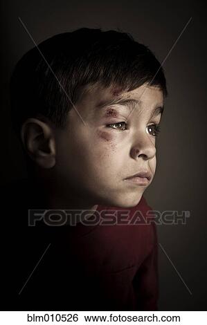 Stock Photograph - Mixed race boy with scrapes on his face. Fotosearch