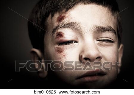 Stock Photography - Mixed race boy with scrapes on his face. Fotosearch