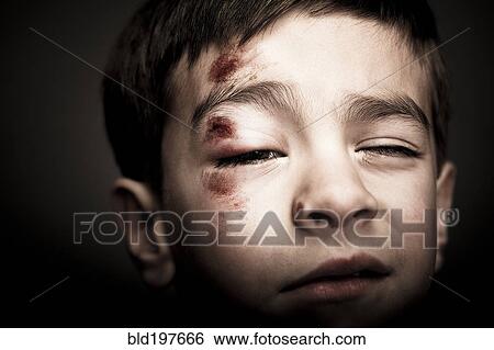 Stock Photograph - Mixed race boy with scrapes on his face. Fotosearch