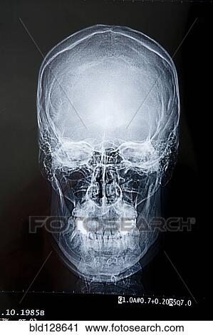 Stock Image - Close up of x-ray of skull. Fotosearch