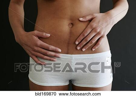 Stock Image - Close up of Hispanic woman with surgical scar. Fotosearch
