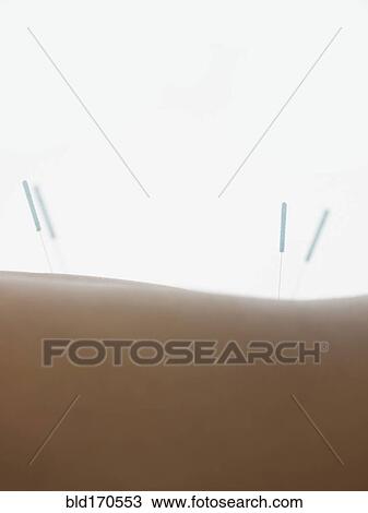 Stock Image - Close up of acupuncture needles in back of woman. Fotosearch