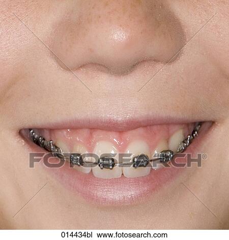 close-up of smiling child with dental braces on their teeth View Large Photo Image Stock Image - close-up of smiling child with dental braces on their teeth. Fotosearch