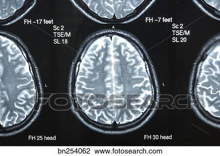 Brain X Ray Stock Image Bn254062 Fotosearch