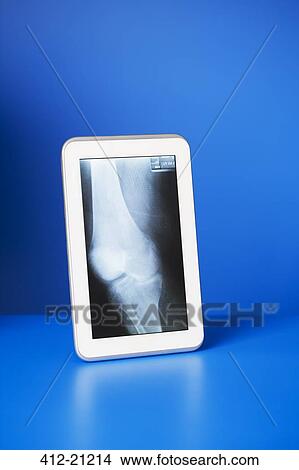 Digital tablet displaying x-ray on blue counter View Large Photo Image Picture - Digital tablet displaying x-ray on blue counter. Fotosearch