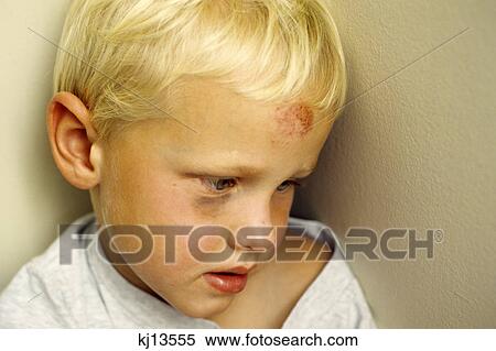 1980S Boy With Bruised Forehead Stock Photography ...