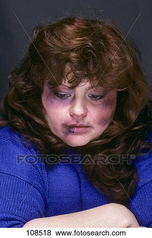 Stock Photo - 1990S Battered Woman With Bruised Face Black Eye Abused Injured Beaten . Fotosearch