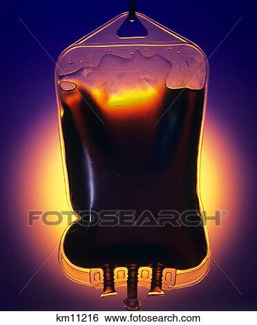 Stock Photograph - Hemoglobin In Plastic Bag Ready For Infusion. Fotosearch