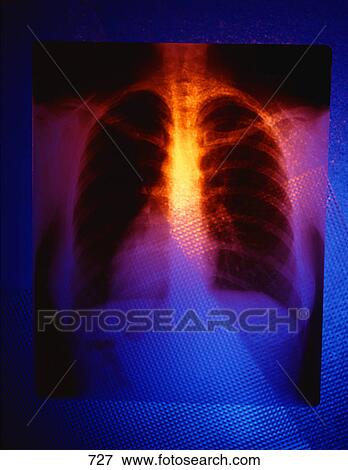 Stock Photo - Color x-ray of chest cavity. Fotosearch