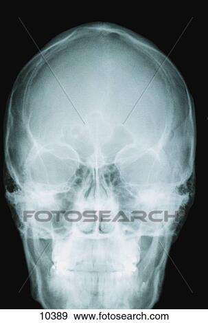 Stock Photo - X-ray image of human skull. Fotosearch