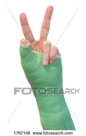 Arm in a cast View Large Photo Image Stock Photograph - Arm in a cast. Fotosearch