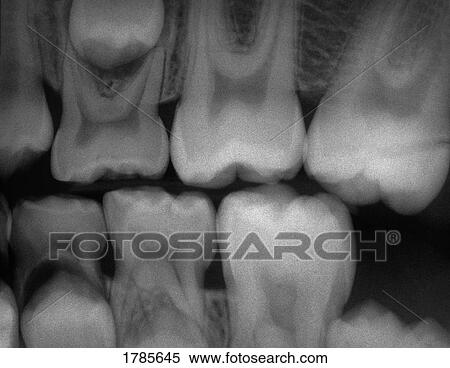Dental x-ray View Large Photo Image Stock Photography - Dental x-ray. Fotosearch