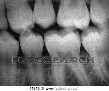 Stock Photograph - Dental X-Rays. Fotosearch