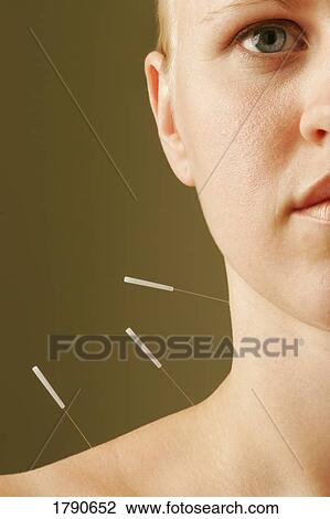Stock Image - Women receiving acupuncture treatment. Fotosearch