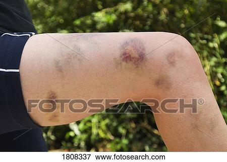 Stock Photo - Bruised leg. Fotosearch