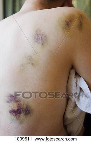Stock Image - Bruising on a woman's back and shoulder. Fotosearch