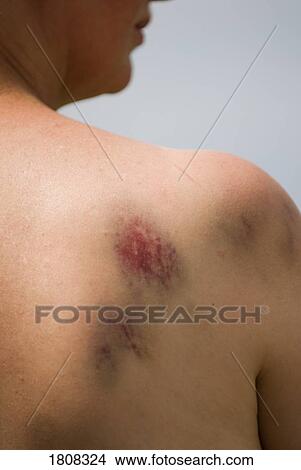 Bruising on woman's right shoulder View Large Photo Image Picture - Bruising on woman's right shoulder . Fotosearch