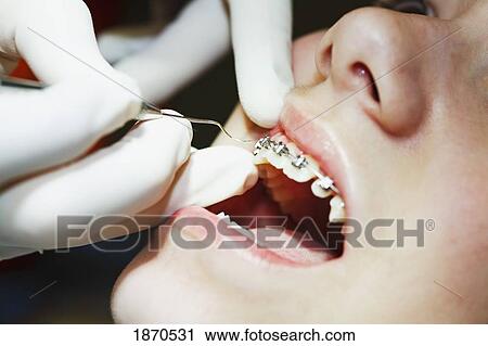 a teenager with braces having their mouth examined by the dentist View Large Photo Image Stock Image - a teenager with braces having their mouth examined by the dentist. Fotosearch