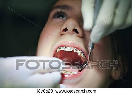 a teenager with braces having their mouth examined by the dentist View Large Photo Image Stock Photo - a teenager with braces having their mouth examined by the dentist. Fotosearch