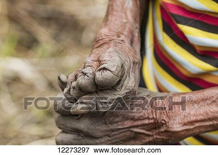 Stock Photo - Hands of a Yali woman who cut her fingers whilst grieving over the death of a relative, Baliem Valley, Central Highlands of Western New Guinea, Papua, Indonesia. Fotosearch