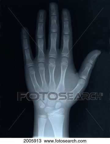 Stock Image - Fl6433, G. Biss Photography Ltd.; X-Ray Of Hand. Fotosearch
