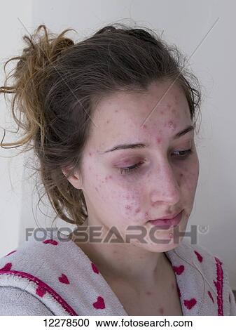 Stock Image - Teenager with chickenpox; England. Fotosearch