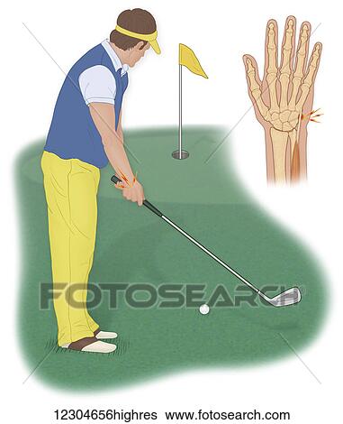 Stock Photograph - A golfer can develop an acute extensor carpi ulnaris tendinitis injury from improper grip of a golf club and over use. Fotosearch