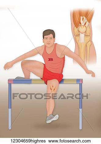 Stock Photograph - A leg and knee injury sustained from a repetitive motion. Fotosearch