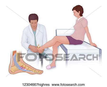 Stock Photograph - Accessory Navicular Pain Syndrome is caused by friction and pressure of the tendons as they pass in proximity to a joint commonly caused by high impact activities. Fotosearch