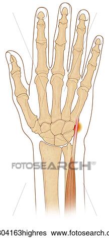 Anterior view of hand bones with inflamed extensor carpi ulnaris muscle View Large Photo Image Stock Photograph - Anterior view of hand bones with inflamed extensor carpi ulnaris muscle. Fotosearch