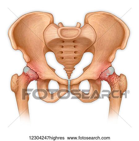 Anterior view of pelvis with hip bones showing arthritis and osteophytes on femoral heads View Large Photo Image Stock Photograph - Anterior view of pelvis with hip bones showing arthritis and osteophytes on femoral heads. Fotosearch