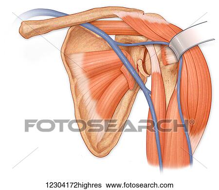 Stock Photograph - Anterior view of the shoulder joint, hilighting reflected deltoid to show torn subscapularis muscle and fractured infraglenoid tubercle, also showing supraspinatus, subscapularis and biceps muscles. Fotosearch