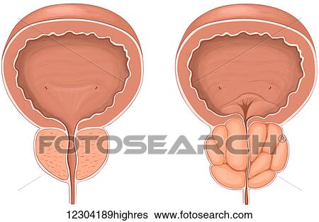 Stock Photograph - Anterior view showing normal versus enlarged prostate gland. Fotosearch