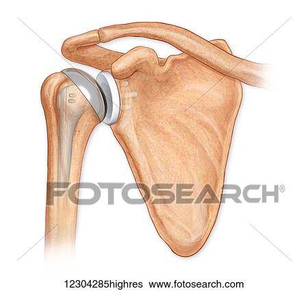 Anterior view total shoulder joint repair View Large Photo Image Stock Photograph - Anterior view total shoulder joint repair. Fotosearch