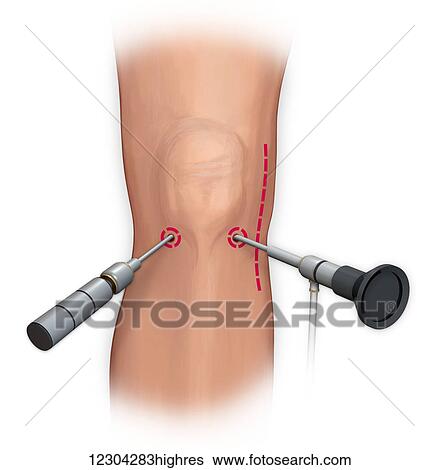 Stock Photograph - Arthroscopic surgical repair of the knee. Fotosearch