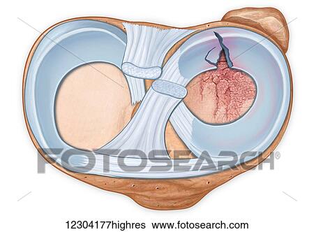 Stock Photograph - Axial view of fractured tibia and torn meniscus. Fotosearch