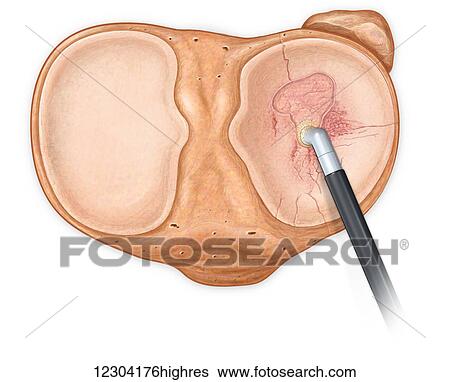 Stock Photograph - Axial view of fractured tibia bone showing cobalation. Fotosearch