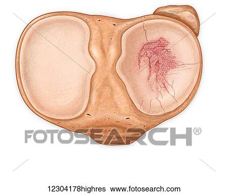 Axial view of fractured tibia bone View Large Photo Image Stock Photograph - Axial view of fractured tibia bone. Fotosearch