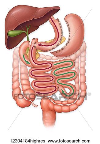 Bilio pancreatic diversion surgery and abdominal organs View Large Photo Image Stock Photograph - Bilio pancreatic diversion surgery and abdominal organs. Fotosearch