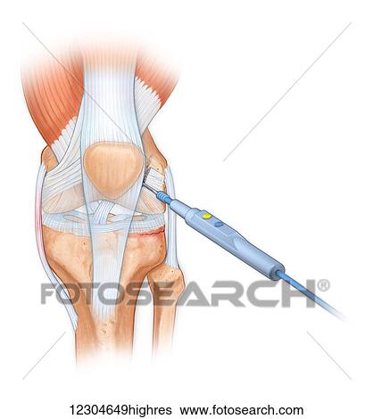 Stock Photograph - Bovie used to cut through retincaculum, and clean up femur of Displaced patellar knee bone. Fotosearch