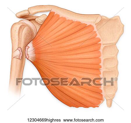 Stock Photograph - Complete rupture of the pectoralis major tendon from the humerus, due to pectoralis major tear syndrome. Fotosearch