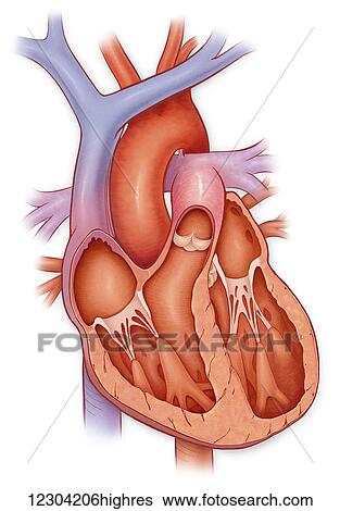 Stock Photograph - Cross section of a heart with an enlarged ventricle. Fotosearch