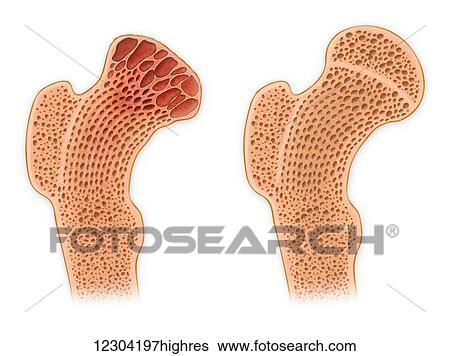 Stock Photograph - Cross section of the head of the femur showing normal bone marrow versus arthritic bone marrow. Fotosearch