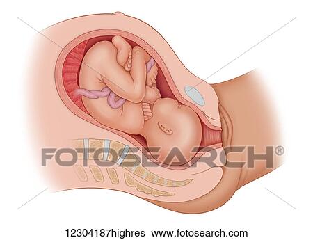 Stock Photograph - Cross section of the mother's anatomy showing the baby in uteruo ROP, in the wrong position. Fotosearch